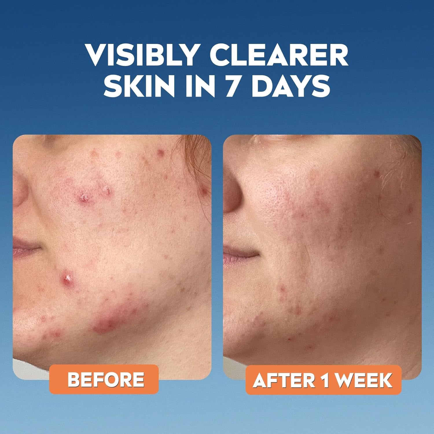 Derma Skin Clear Scrub (150Ml), Exfoliating Face Scrub, Salicylic Acid Face Wash Enriched with Niacinamide to Unclog Pores and Refine Textures, for Blemish-Prone Skin